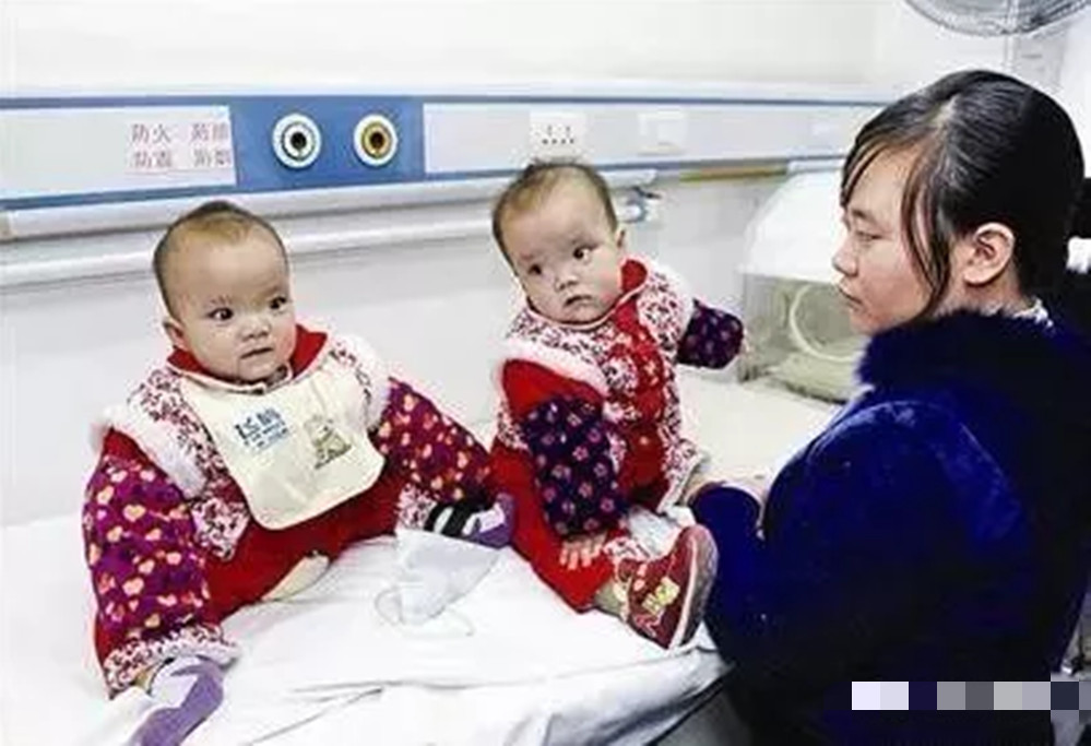 双胞胎坐骨连体成功案例,坐骨连体姐妹分离成功了吗