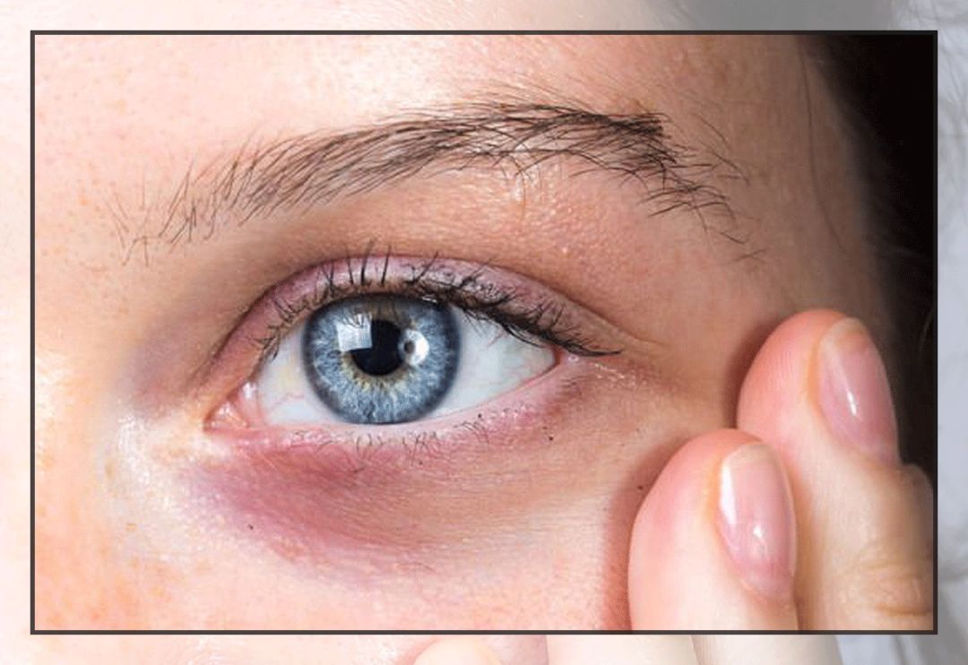 董氏奇穴一针治疗黑眼圈,熊猫针一针就能去掉黑眼圈吗