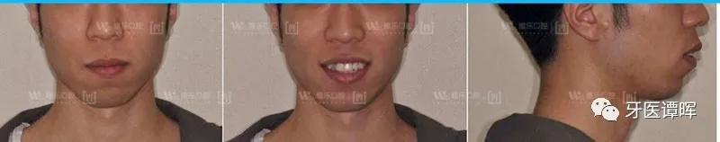 牙齿拥挤9个月变化图,牙齿拥挤排齐后嘴会凸吗