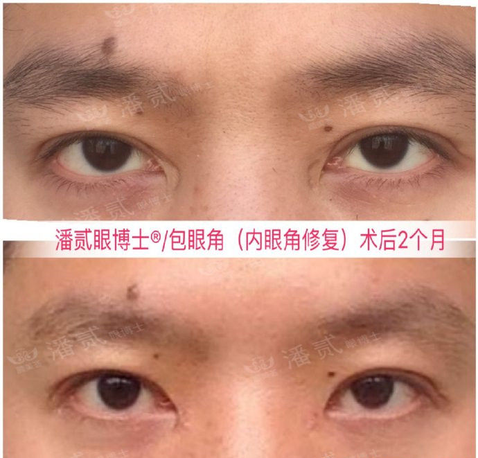 开眼角手术如何避免回缩,开眼角手术常见问题及解决方法