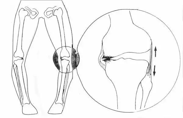 足内翻导致足弓疼,足内翻会导致什么腿型怎么改