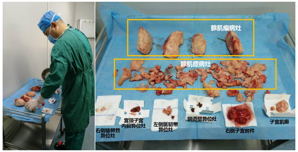 痛经腺肌症会引起不孕吗,腺肌症导致痛经如何治疗