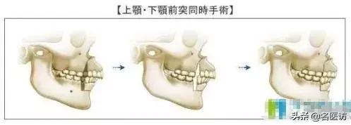 戴牙套2年不戴保持器反弹案例,戴牙套成功案例不戴保持器