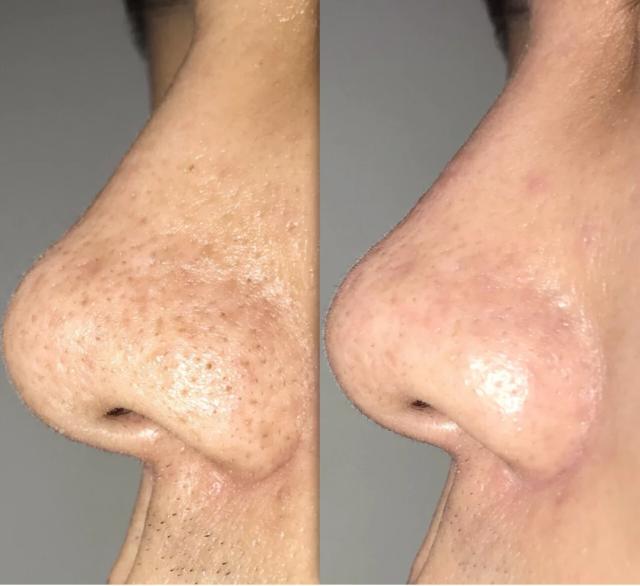 美容院去黑头前敷的东西,美容院去黑头面膜