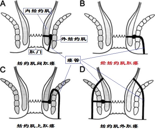 肛瘘lift手术天津哪有医院使用,北京哪家医院能做lift肛瘘手术