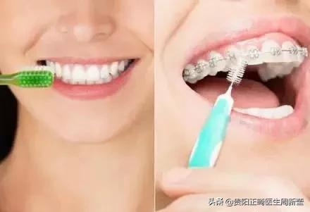 三种牙套大PK，优势对比一目了然