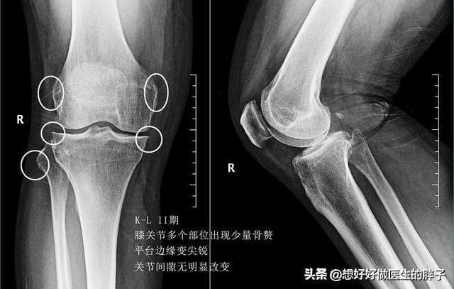 骨刺与骨性关节炎疼痛有什么区别,关节炎骨刺是怎么造成的