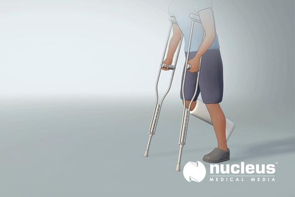 踝关节肿胀期间必须要卧床抬高吗,踝关节扭伤三天肿胀能轻轻活动吗