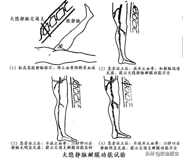 经常站立导致小腿静脉曲张,大腿上有小蚯蚓是不是静脉曲张