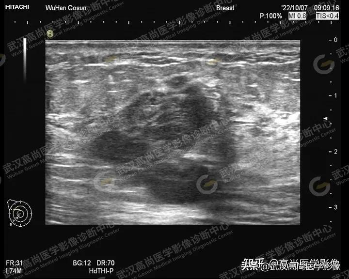 乳腺超声病例,乳腺肿块巨大超声结果4a