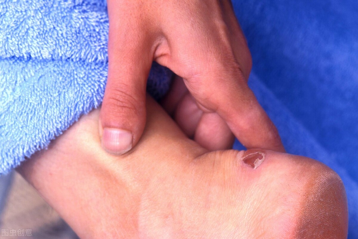 跑步脚丫磨泡了怎么办,跑步脚磨个泡怎么处理
