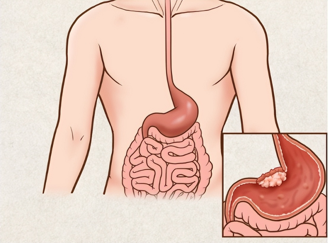 胃穿孔的症状及治疗方法,胃穿孔什么治疗方法好