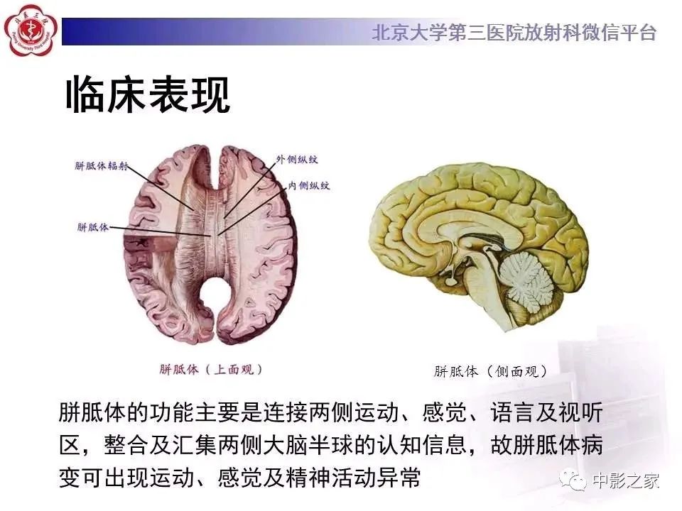 什么叫原发性胼胝体变性,原发性胼胝体变性治疗多少钱