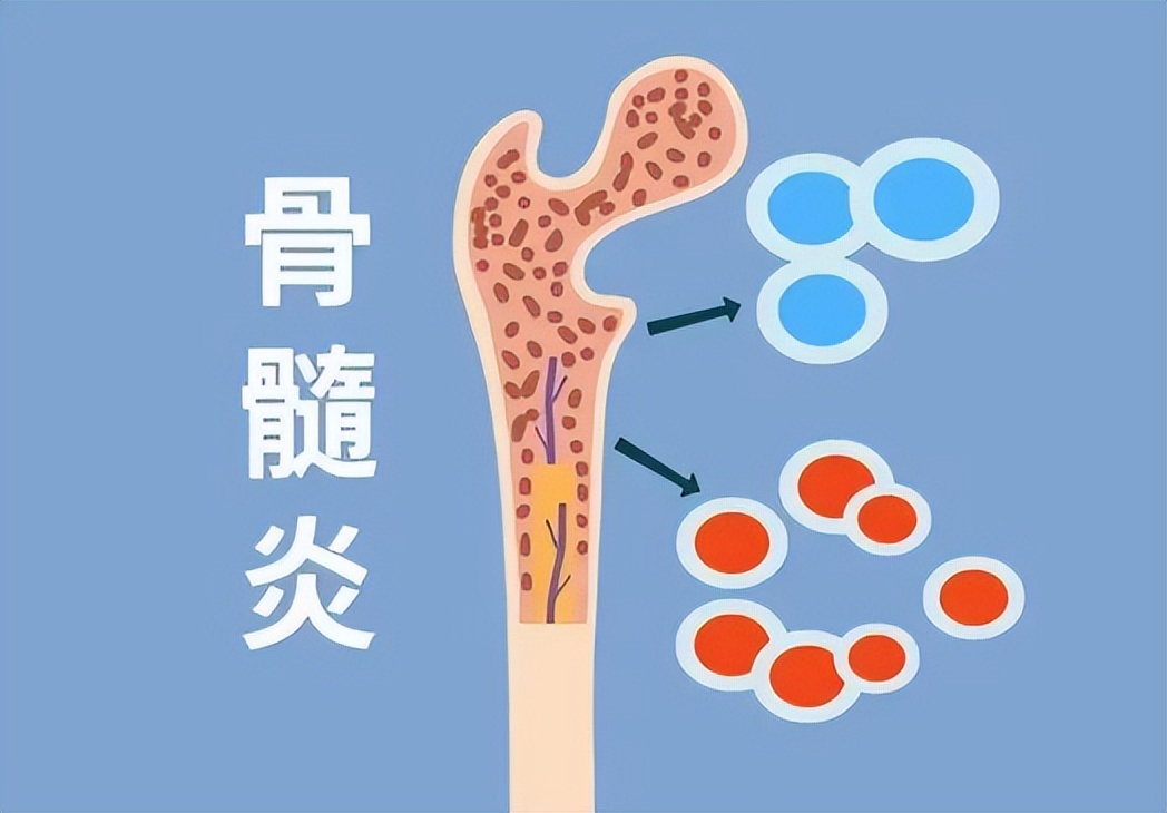 开放性骨折引起骨髓炎的症状,脚踝骨折严重骨髓炎什么症状