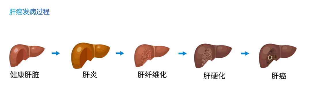 戊型肝炎会引起肝癌吗,由肝炎引起肝癌的比例