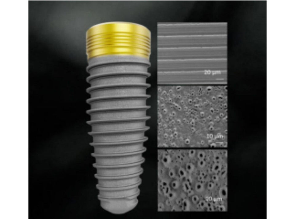 瑞士诺贝尔高端种植牙,诺贝尔金致植体奥齿泰