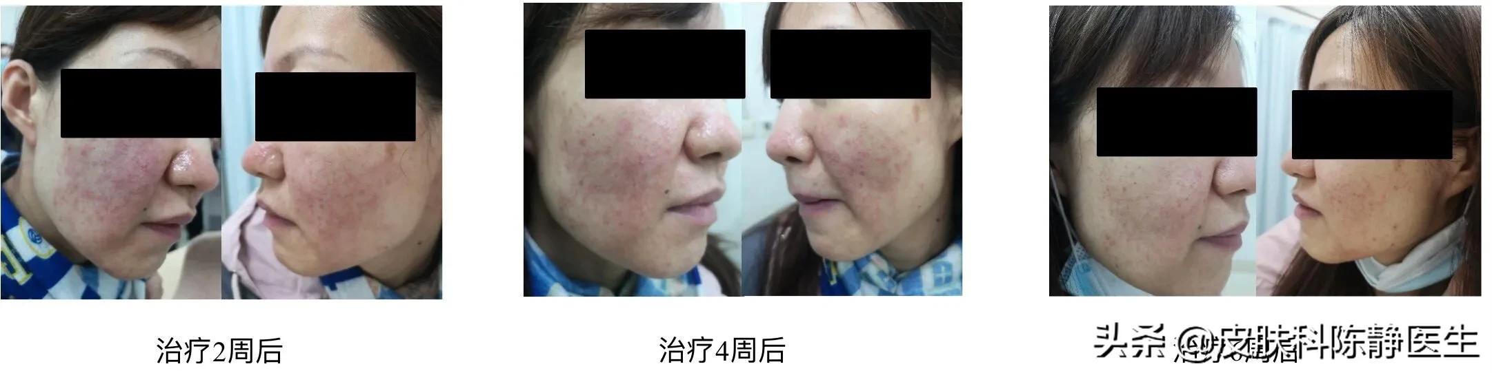 克立硼罗软膏是新药吗,克立硼罗软膏能治光敏性皮炎吗