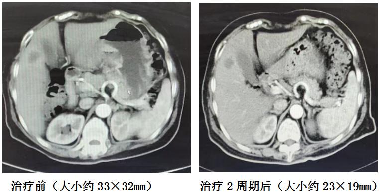 全国治胃癌最好的化疗方案,肿瘤科常见化疗方案解读