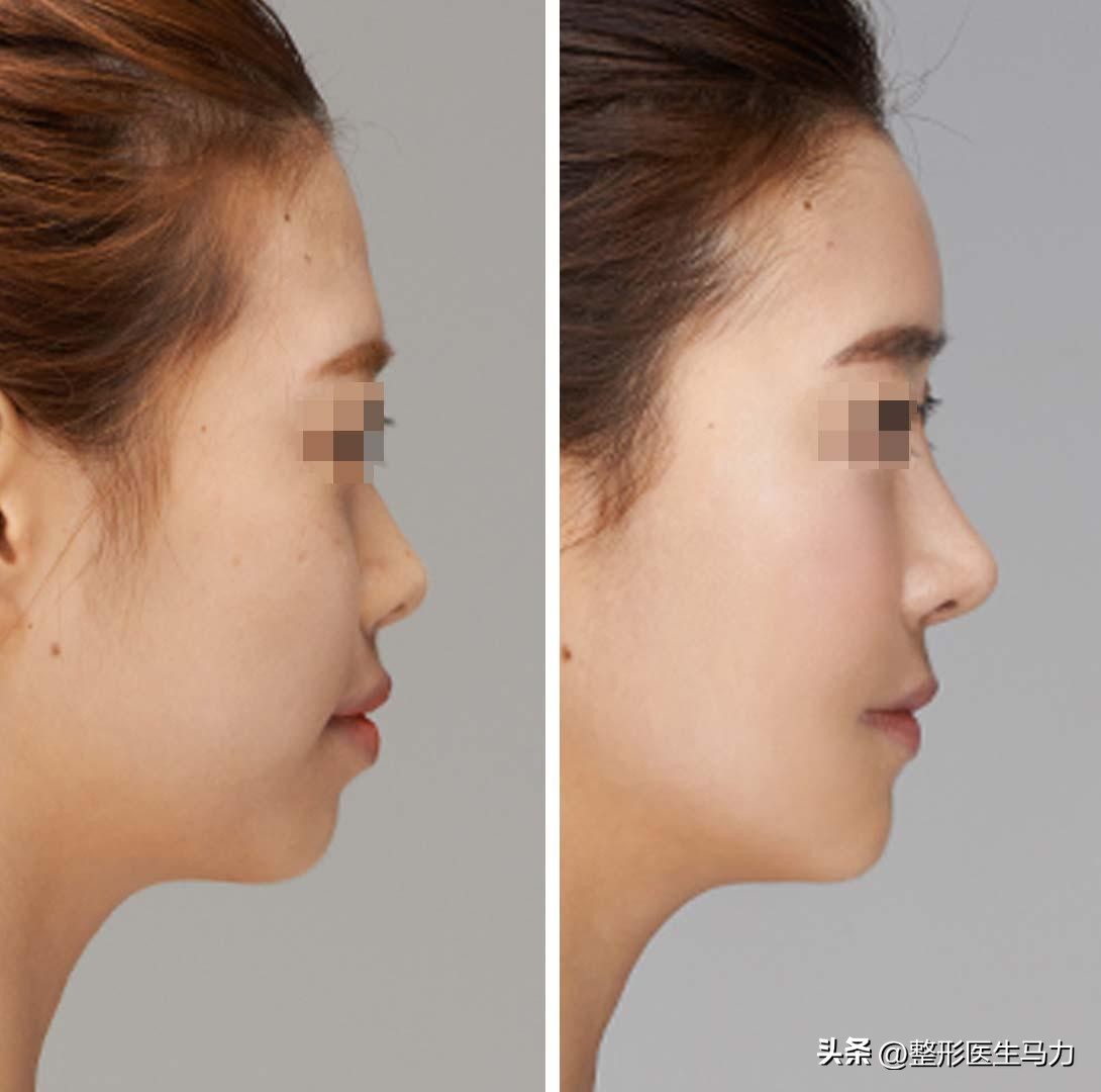 三甲医院整形医生才敢说的大实话,玻尿酸填充次数多了会有后遗症么