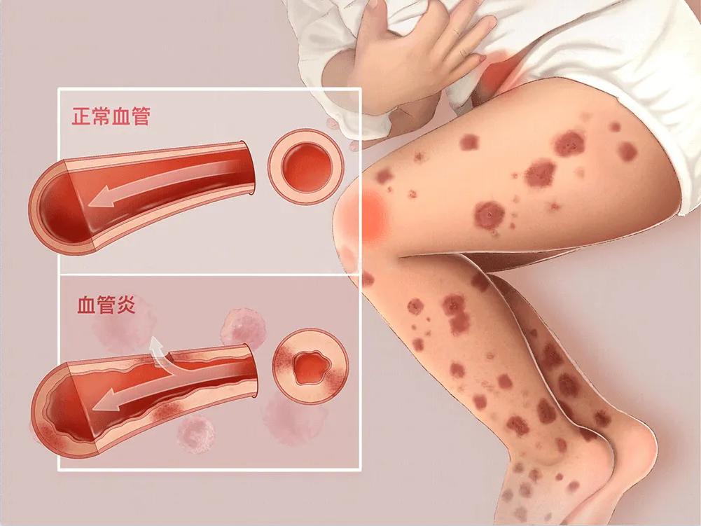 治紫癜别急着用药，先弄明白这些，盲目治疗不可取！