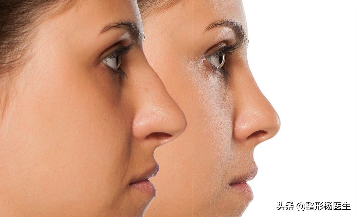 隆鼻怎么做才自然又安全,隆鼻小知识视频