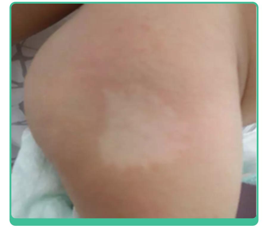 宝宝手上长胎记，一查竟是血管瘤！医生：这5种胎记要早处理