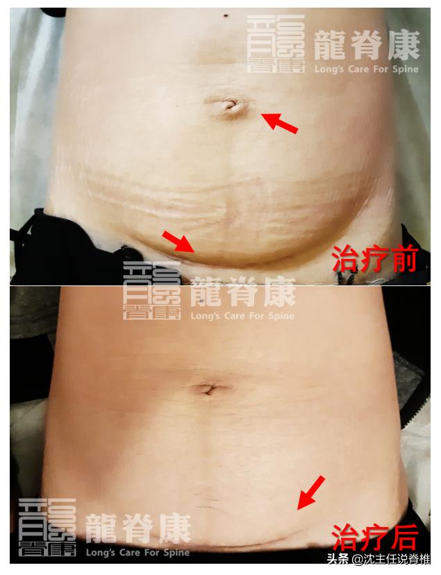 产后内脏下垂小腹突出,产后小腹突出怎么减