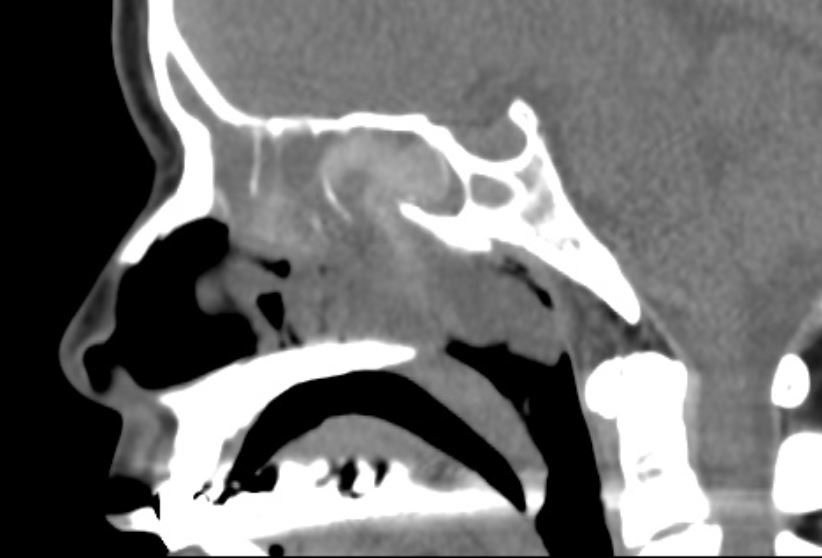 嗜酸性粒细胞性鼻息肉容易复发吗,鼻息肉手术后6个月复发怎么处理