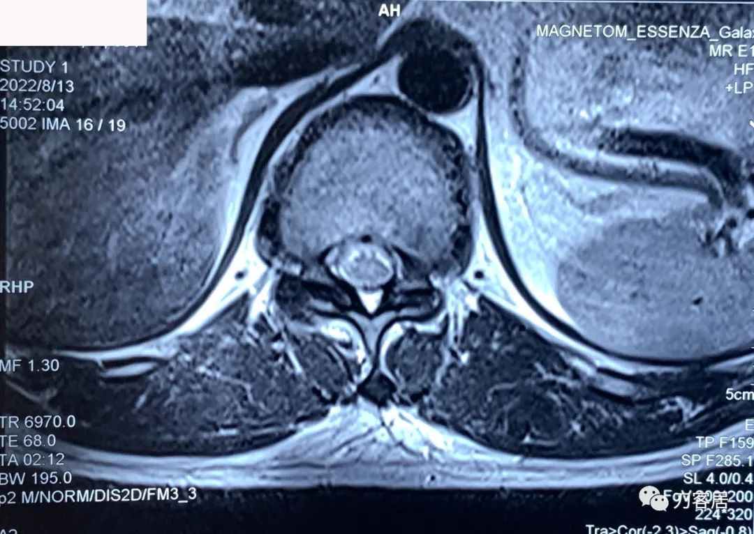 良性单侧下肢肌萎缩,下肢肌肉萎缩24年能治好吗