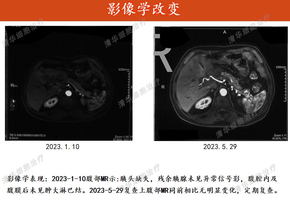 胰腺癌复发率高、预后差，联合细胞治疗提升生存期