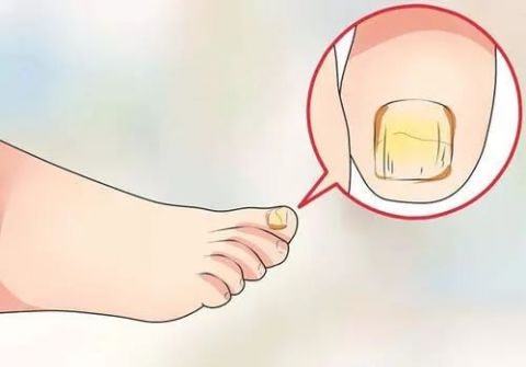 脚趾甲凹凸不平去医院挂什么科,检查脚趾甲挂什么科