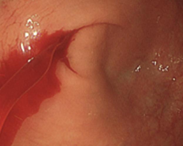 体内有绦虫吃什么食物,女子体内排出4.59米长的绦虫