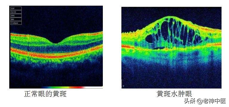 糖尿病视网膜病变眼底出血严重吗,糖尿病眼底出血黄斑病变怎么治
