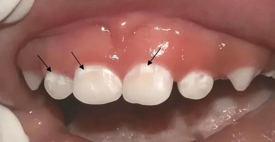 牙齿有点脱矿怎么办,牙齿脱矿了怎么治疗