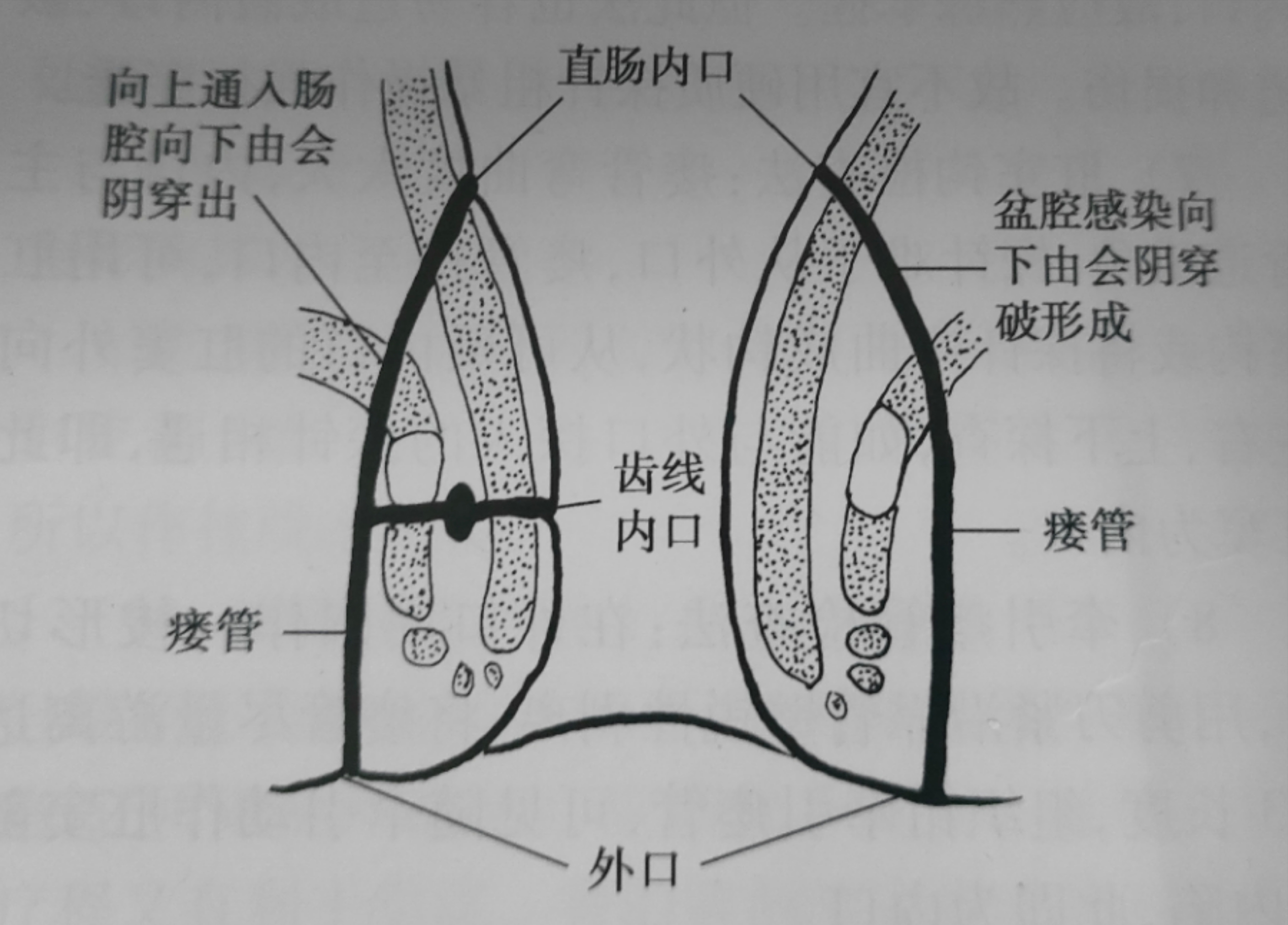 同样是肛瘘,为什么别人术后2天就出院,而我术后七天还出不了院