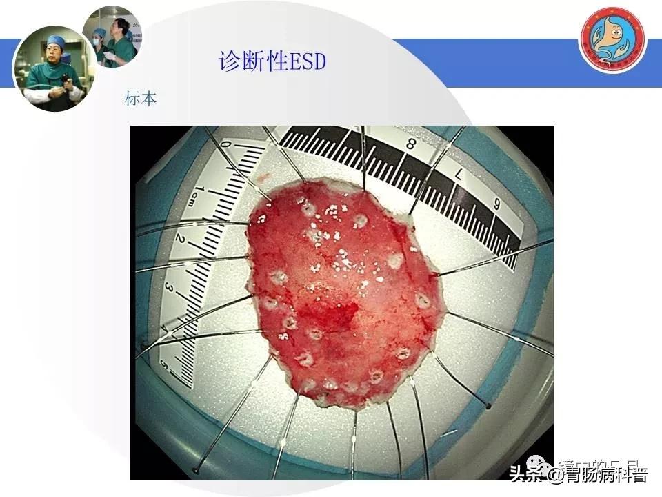 胃癌可以做内镜手术吗,早期胃癌内镜手术后追加外科手术