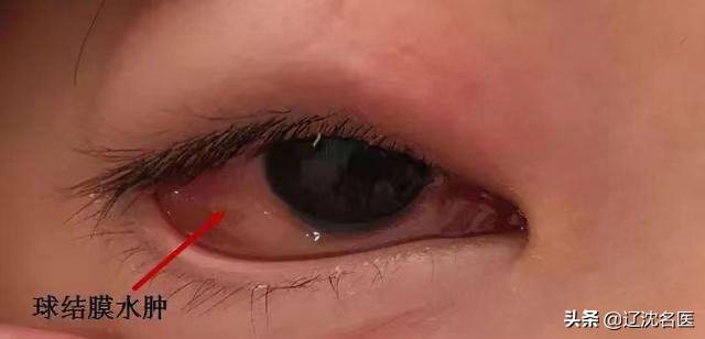 春季过敏性鼻炎结膜炎怎么治疗,过敏性结膜炎的高发季节注意事项