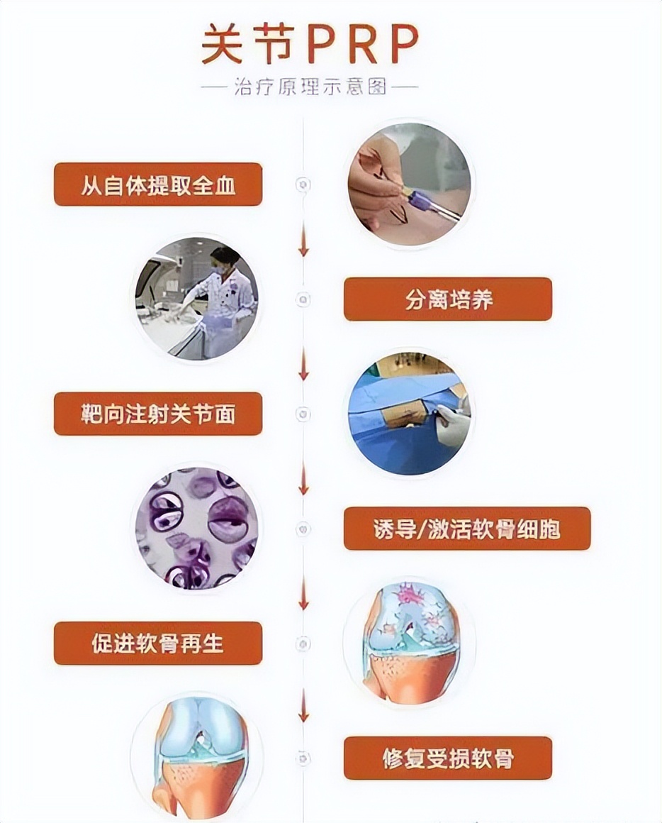 关节prp治疗要打麻药吗,风湿性关节炎prp