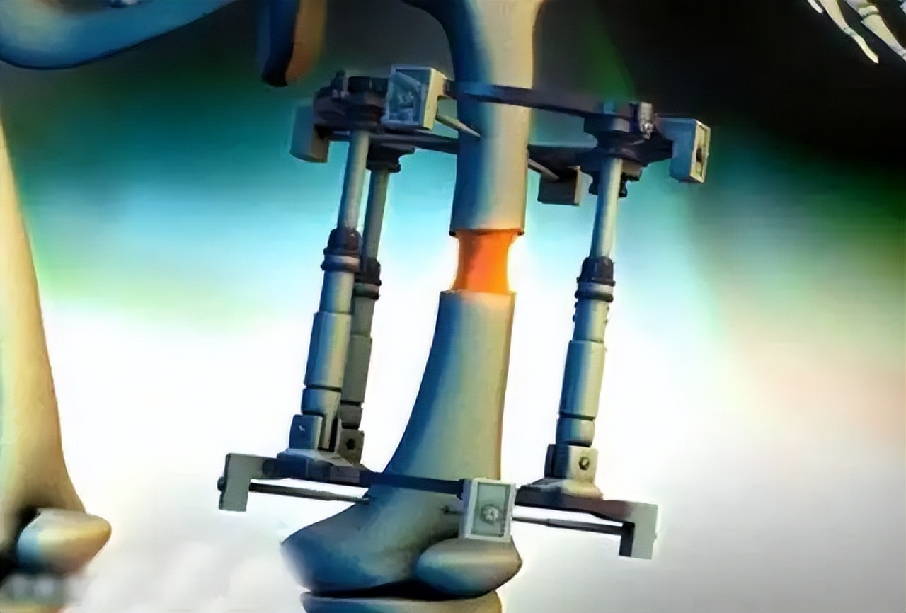 高中生花6.5万断骨增高,1米58男子花1500万增高