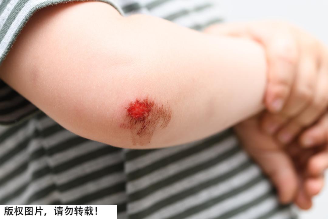 结痂为什么感觉很紧绷,结痂很痒可以抠掉吗