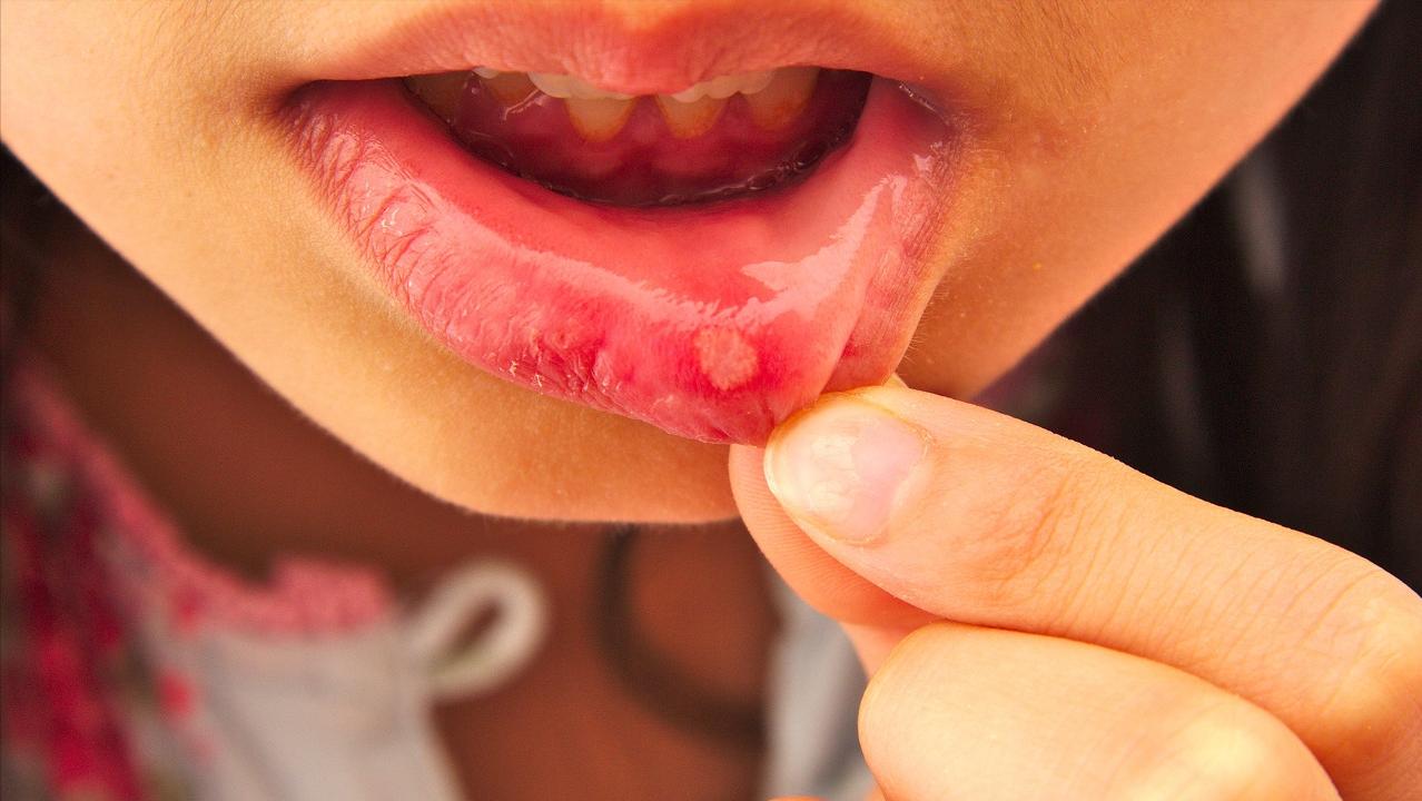 小孩身上有小红点抹啥药,孩子身上起了一个化脓性肉芽肿