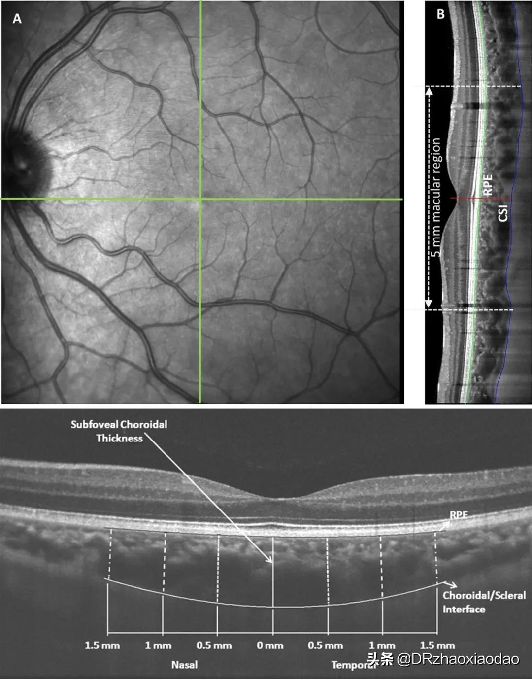 还有人以为脉络膜增厚是坏事吗？看完这篇再说吧