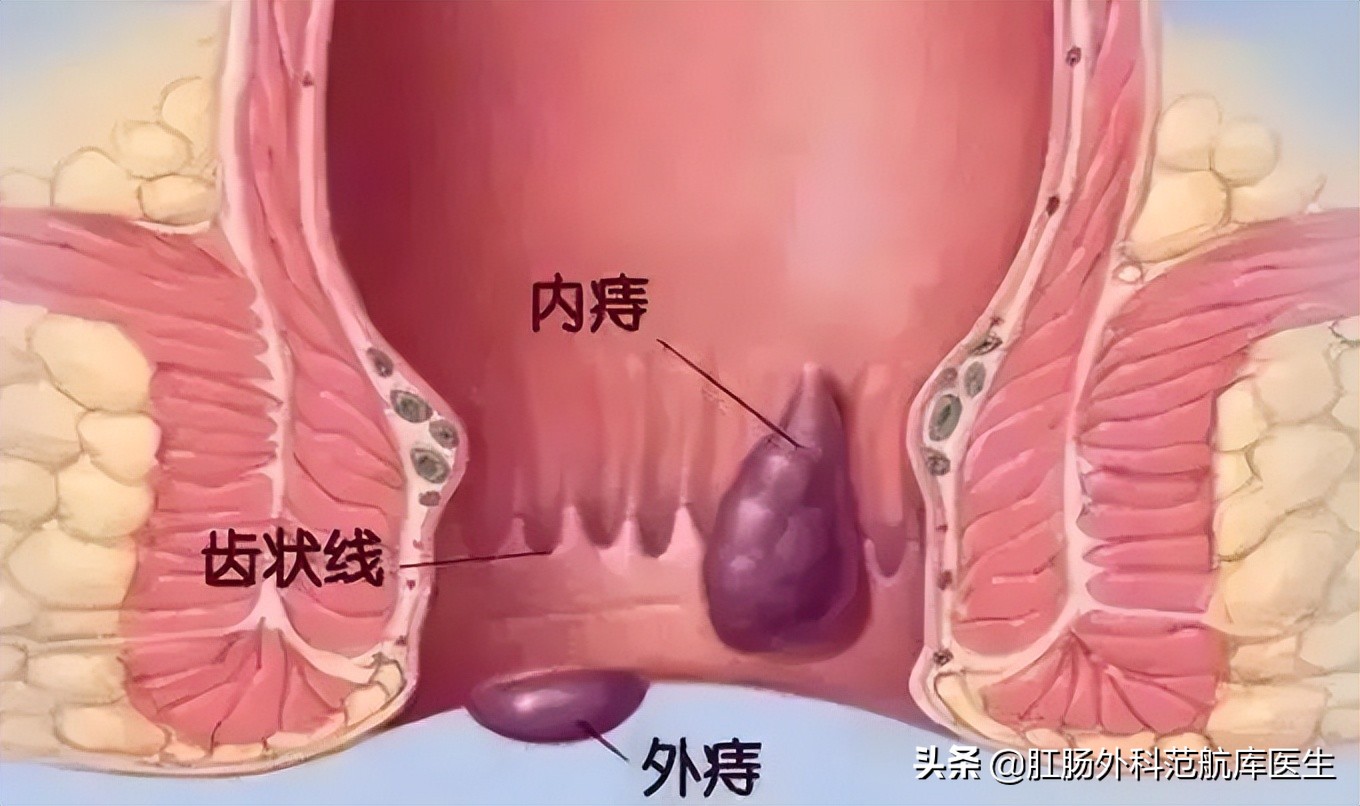 痔疮疼痛等级排名,痔疮术后疼痛难忍