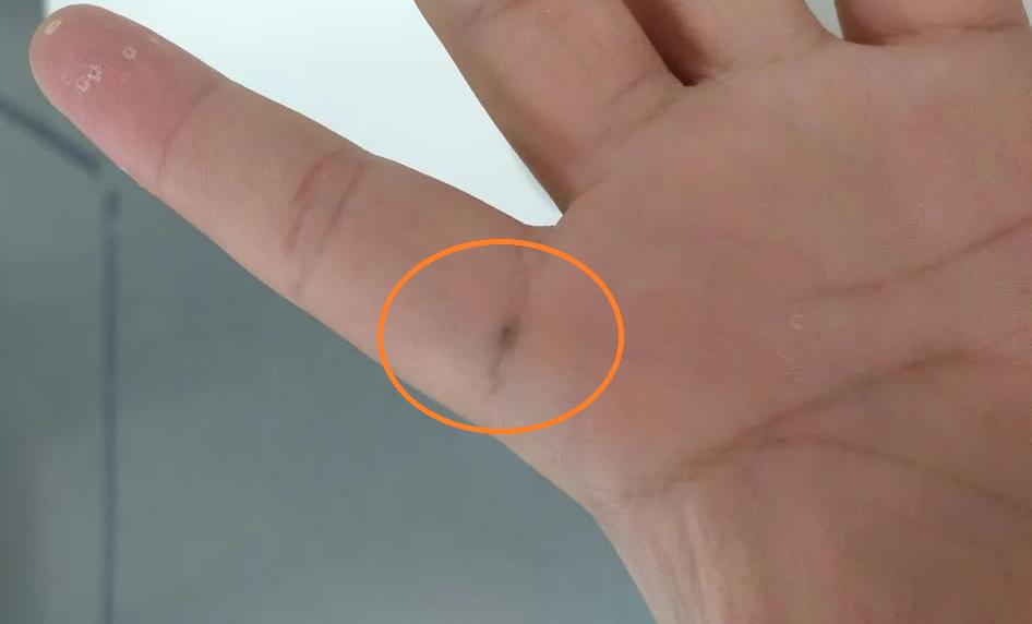 被铅笔扎了怎么办,手里扎铅笔芯不取出的后果