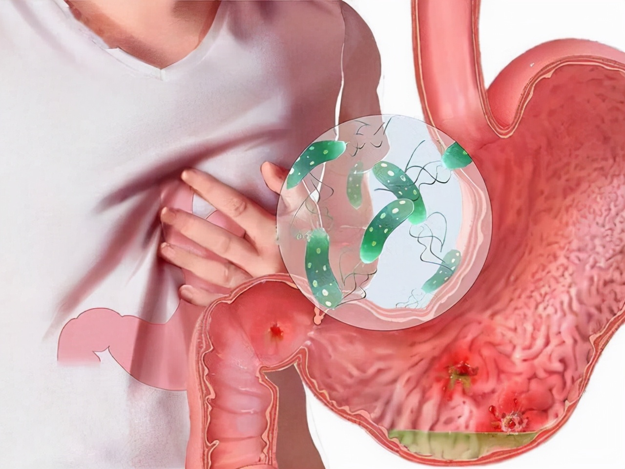 一瓶甲硝唑减轻四种疾病,甲硝唑几块钱和几十块的区别