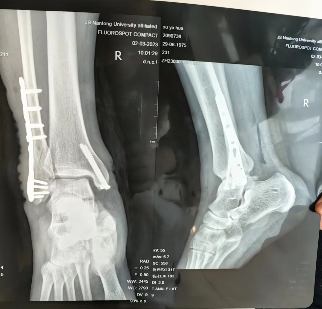 脚踝上侧骨折手术的全过程,脚踝骨折手术费用多少