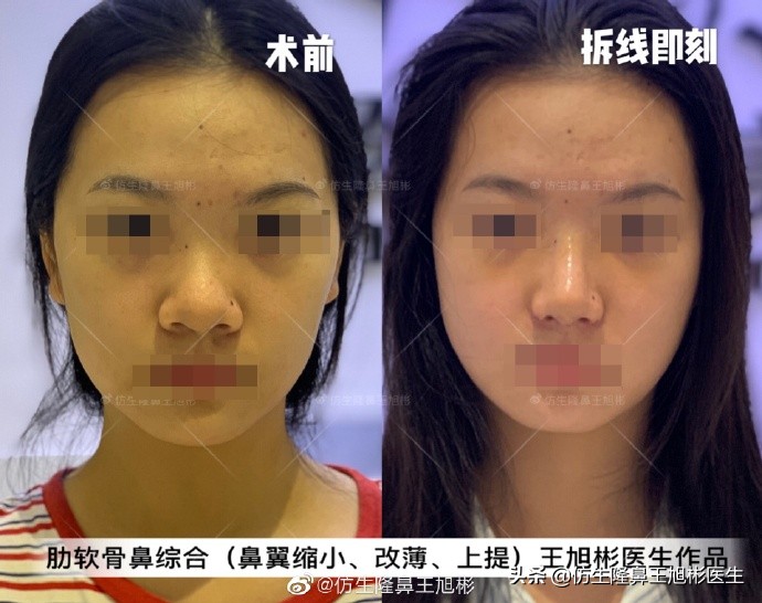 常见鼻部整形美容项目,整形鼻和自然鼻