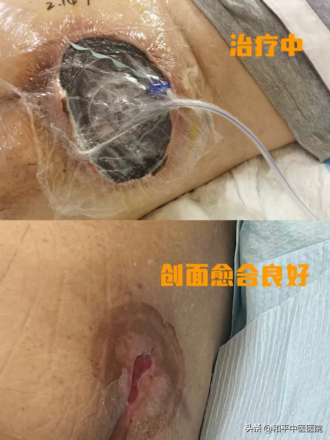 老年人压疮化脓怎么护理,卧床老人一度压疮能治好么