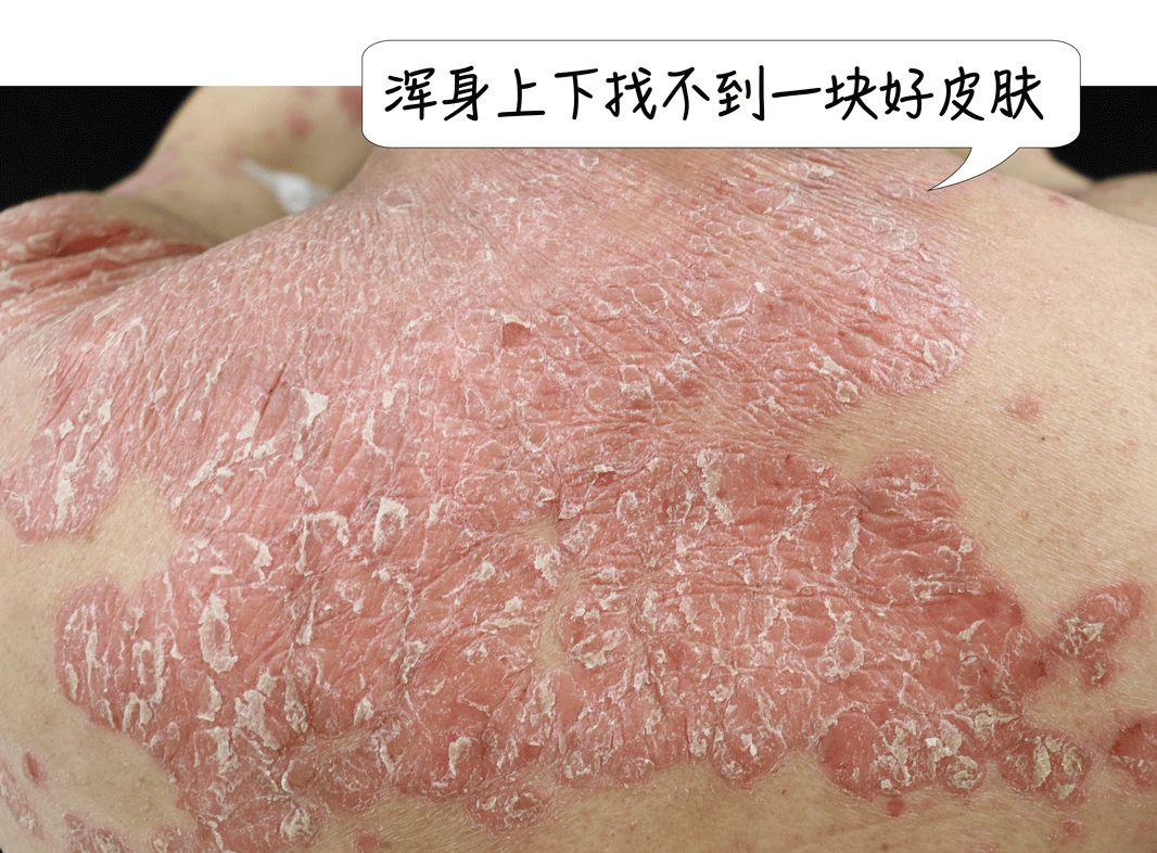 一睡醒，满床都是皮屑！“得了这病，剪发到一半就被赶出来”