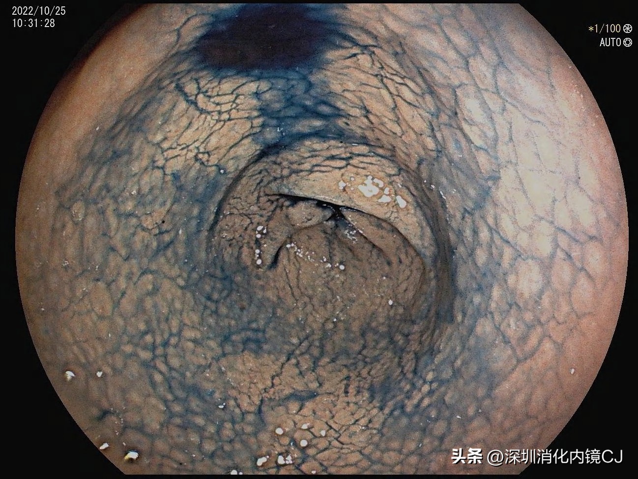 幽门螺旋杆菌感染胃粘膜表现,没有幽门杆菌但是胃窦鸡皮样改变